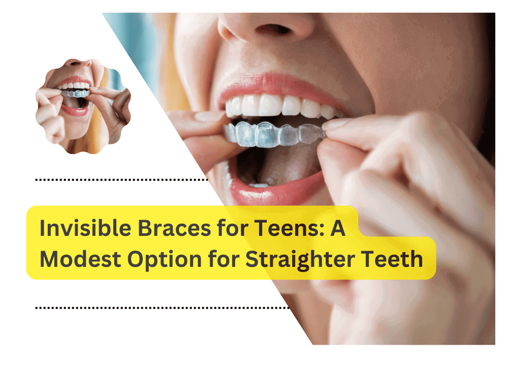Invisible Braces for Teens: A Modest Option for Straighter Teeth
