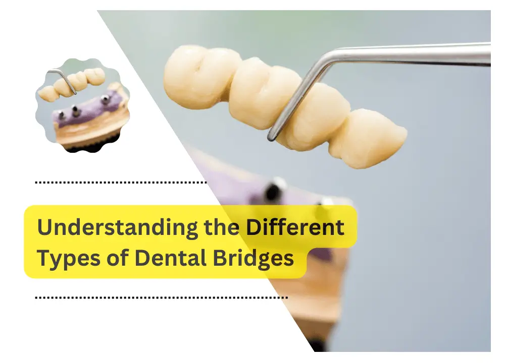 Understanding the Different Types of Dental Bridges