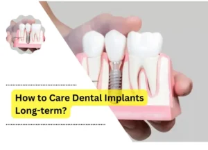 How to Care Dental Implants Long-term?