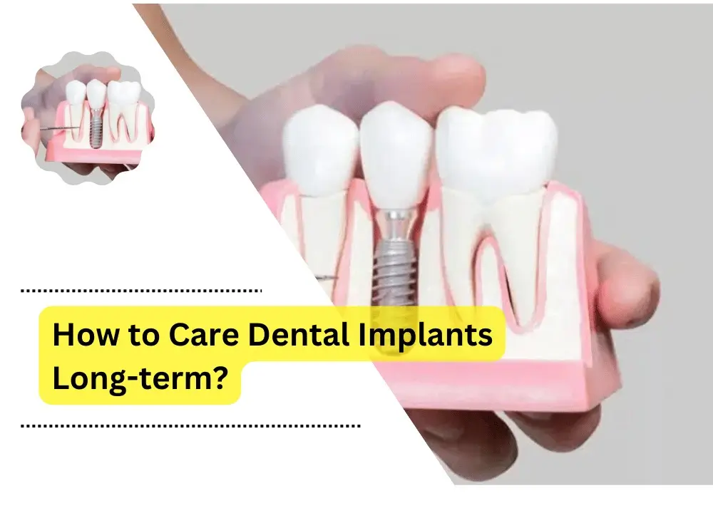 Dental Implants