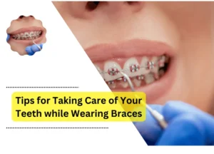 Tips for Taking Care of Your Teeth while Wearing Braces