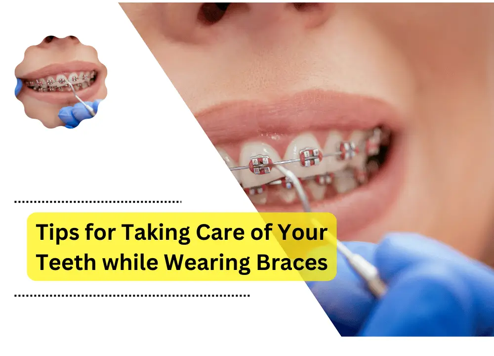 dental braces