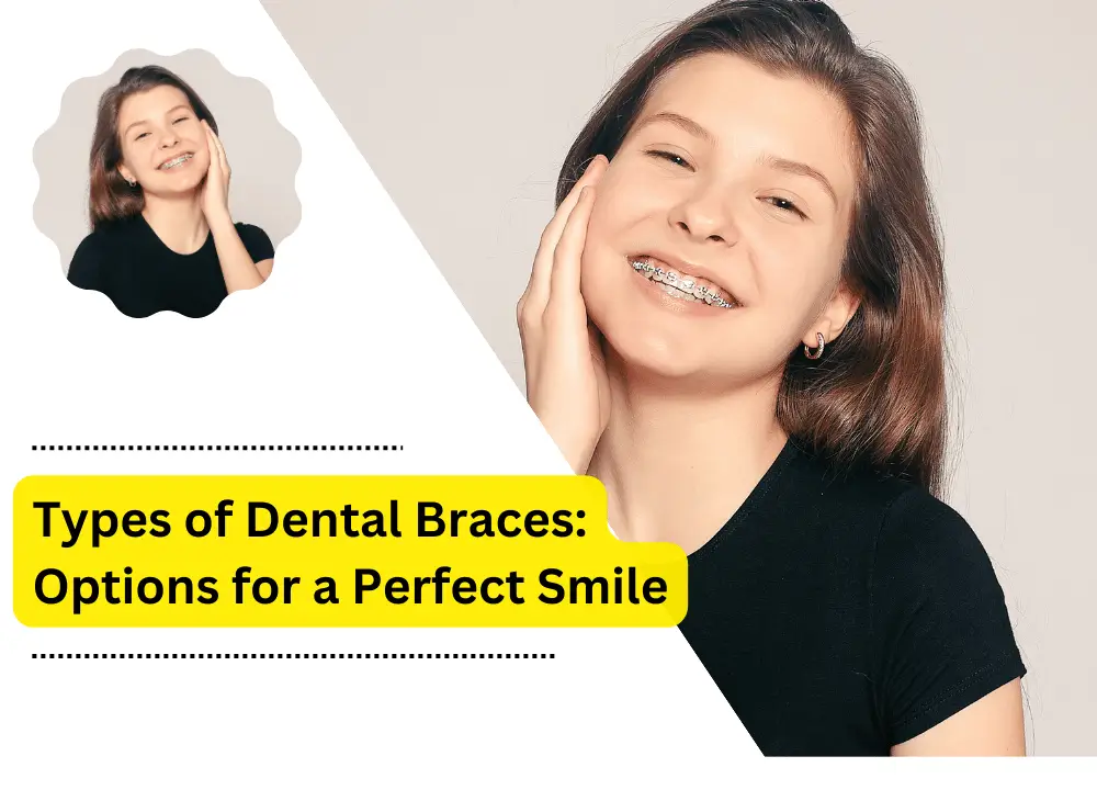 Types of Dental Braces: Options for a Perfect Smile