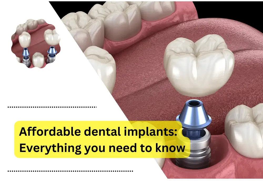 Affordable dental implants